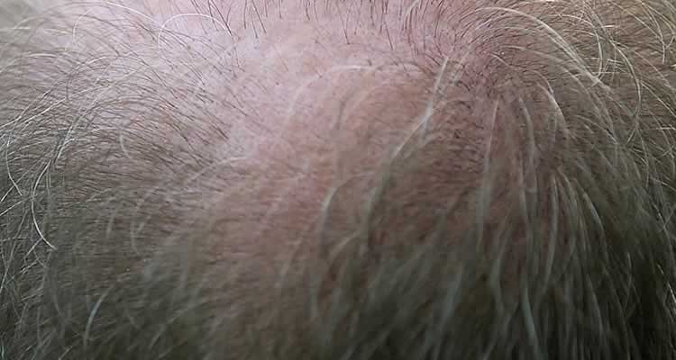Faire de la tricopigmentation des cheveux : une technique efficace pour camoufler les parties chauves